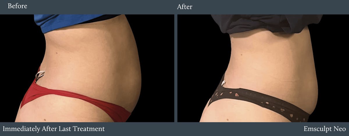 Abdomen Before & After Gallery - Patient 338680 - Image 1