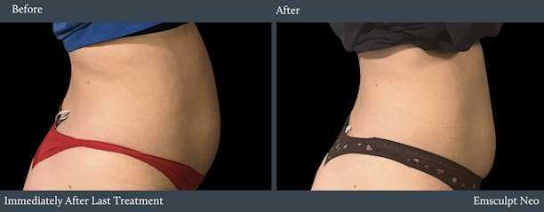 Abdomen Before & After Gallery - Patient 338680 - Image 1