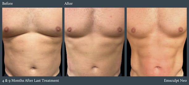 Abdomen Before & After Gallery - Patient 409574 - Image 1