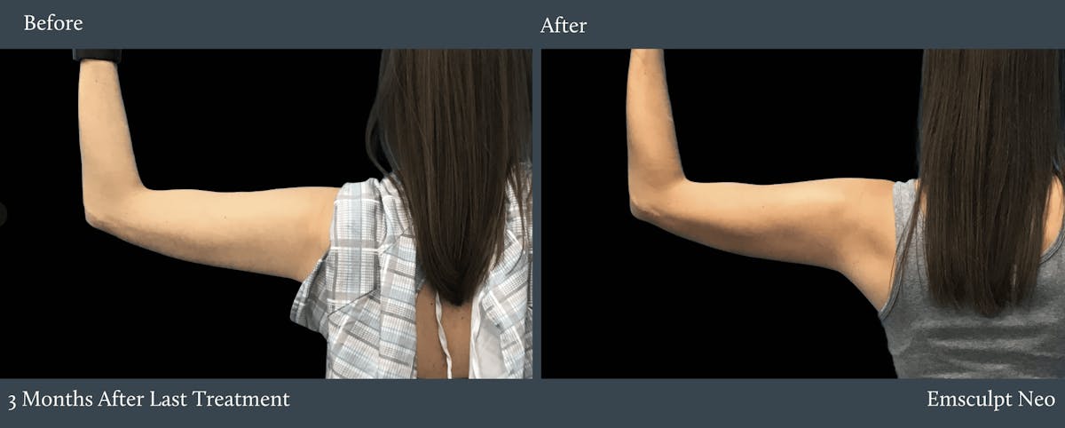 Arms Before & After Gallery - Patient 105961 - Image 1