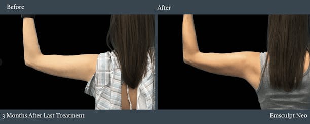 Arms Before & After Gallery - Patient 105961 - Image 1