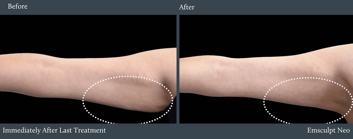 Arms Before & After Gallery - Patient 260617 - Image 1