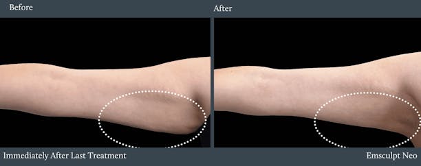 Arms Before & After Gallery - Patient 260617 - Image 1