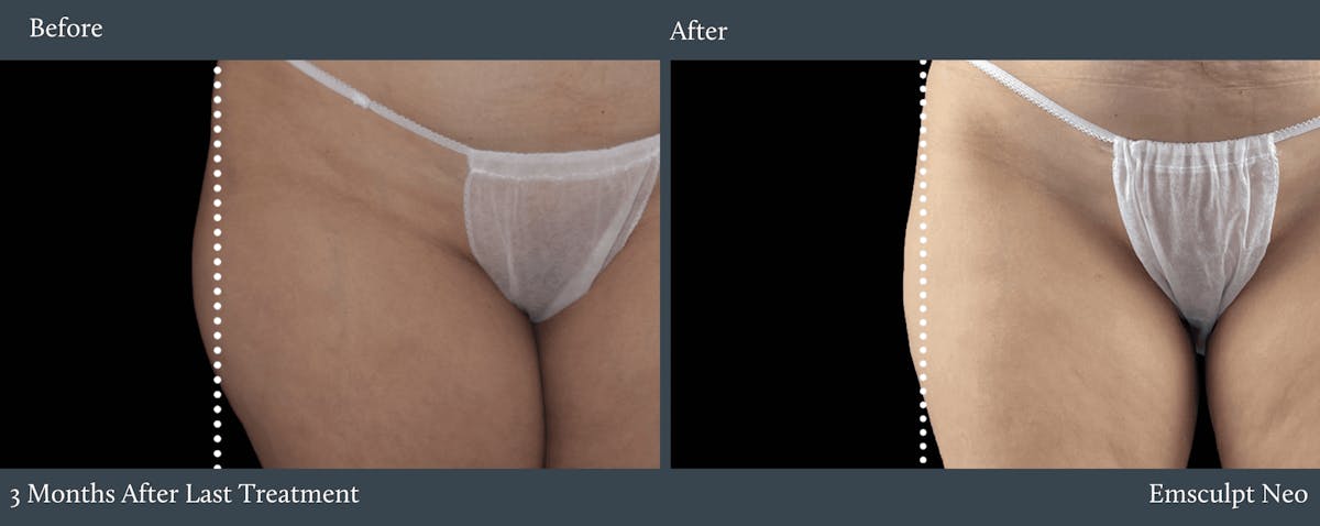 Glutes Before & After Gallery - Patient 428873 - Image 1
