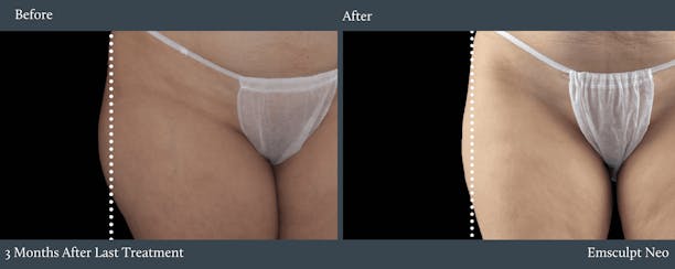 Glutes Before & After Gallery - Patient 428873 - Image 1