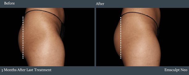 Glutes Before & After Gallery - Patient 334578 - Image 1