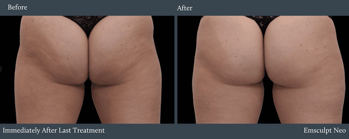 Glutes Before & After Gallery - Patient 832925 - Image 1