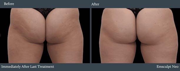 Glutes Before & After Gallery - Patient 832925 - Image 1