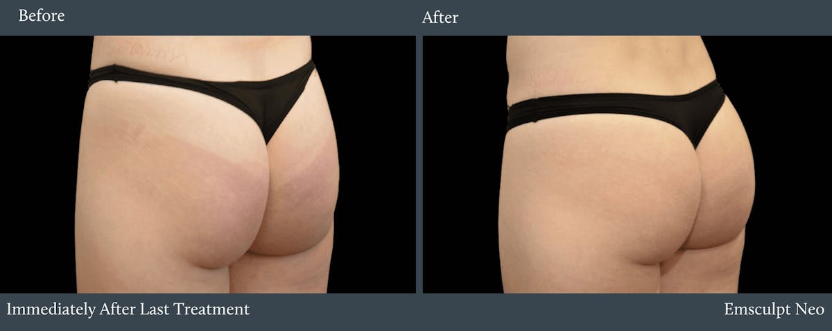 Glutes Before & After Gallery - Patient 229025 - Image 1