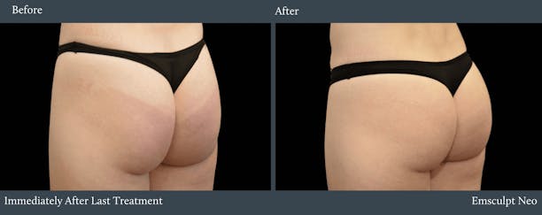 Glutes Before & After Gallery - Patient 229025 - Image 1