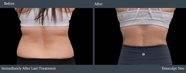 Love Handles Before & After Gallery - Patient 381045 - Image 1