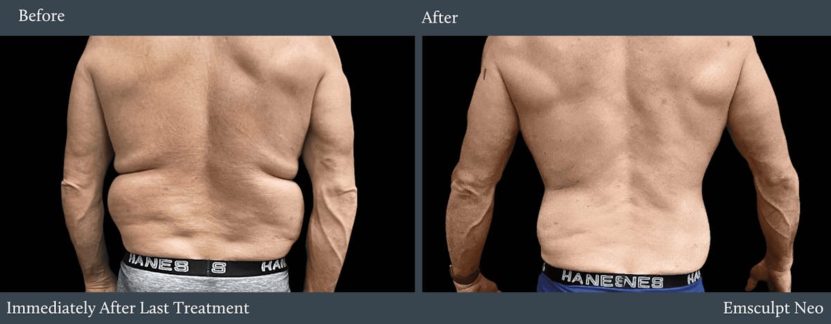 Love Handles Before & After Gallery - Patient 990299 - Image 1