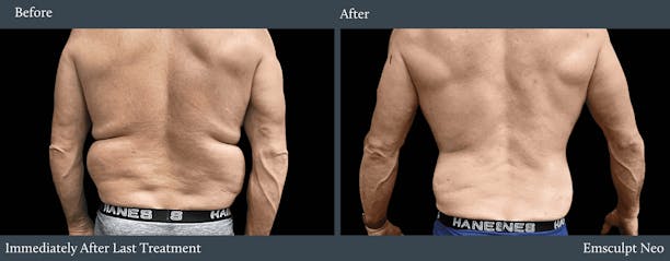 Love Handles Before & After Gallery - Patient 990299 - Image 1