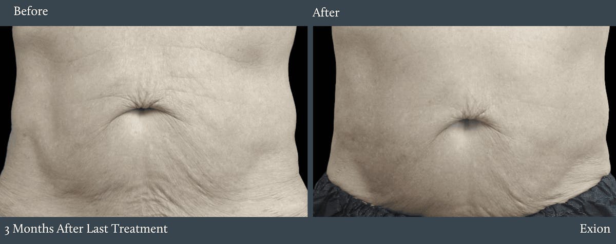 Abdomen Before & After Gallery - Patient 254644 - Image 1