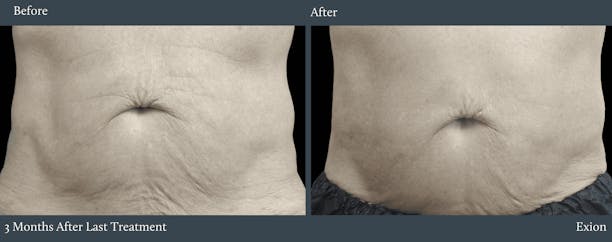 Abdomen Before & After Gallery - Patient 254644 - Image 1