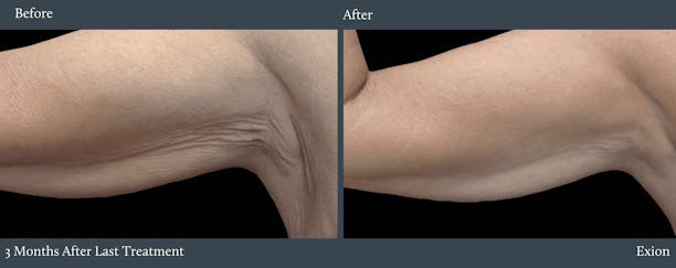Arms Before & After Gallery - Patient 140570 - Image 1