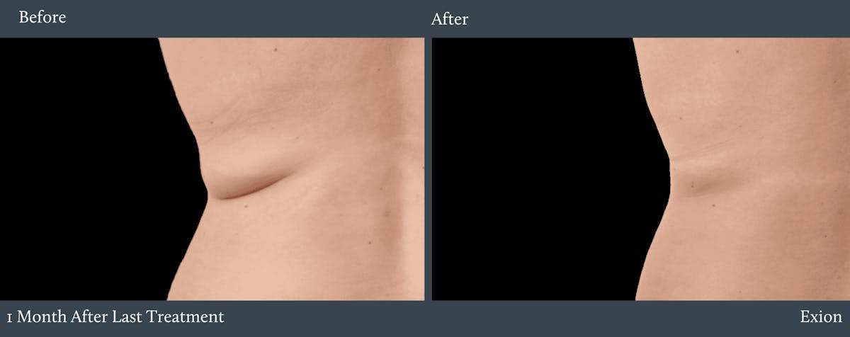 Bra Fat Before & After Gallery - Patient 156590 - Image 1