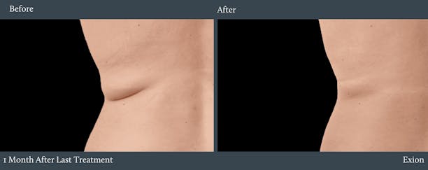 Bra Fat Before & After Gallery - Patient 156590 - Image 1