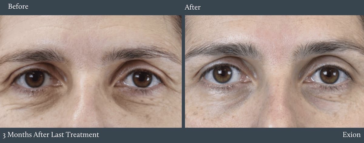 Eyes Before & After Gallery - Patient 301139 - Image 1
