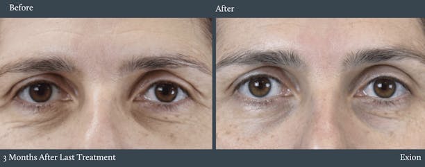 Eyes Before & After Gallery - Patient 301139 - Image 1