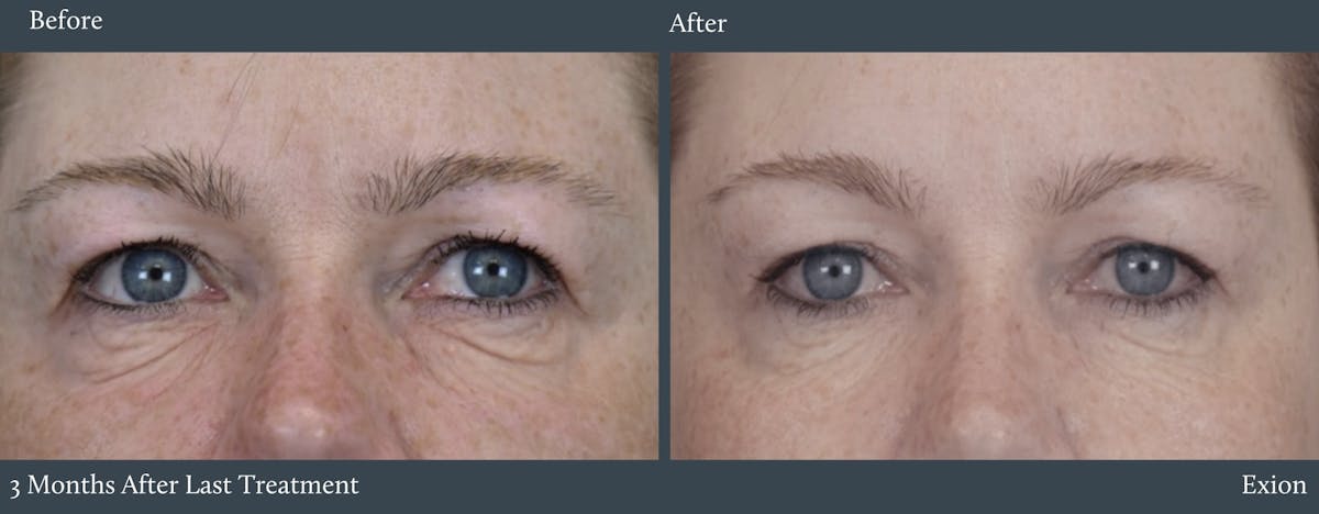 Eyes Before & After Gallery - Patient 189433 - Image 1