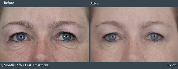 Eyes Before & After Gallery - Patient 189433 - Image 1