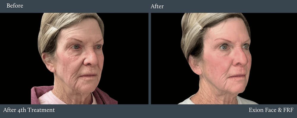 Before and after side by side pictures of a mature woman's face. On the left she appears more mature and tired. On the right, after her 4th Exion Facial RF Ultrasound treatment for acne scars in Chicago, her skin is smoother, glowing, and more youthful.