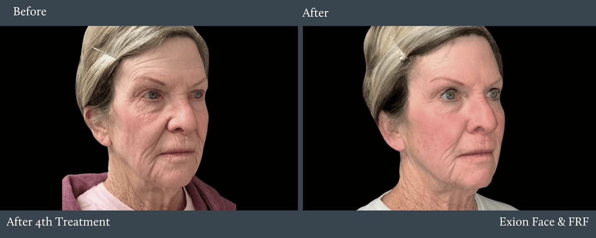 Face Before & After Gallery - Patient 268325 - Image 1