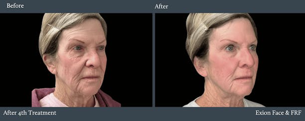 Face Before & After Gallery - Patient 268325 - Image 1