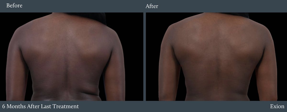 Love Handles Before & After Gallery - Patient 306978 - Image 1