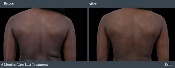 Love Handles Before & After Gallery - Patient 306978 - Image 1