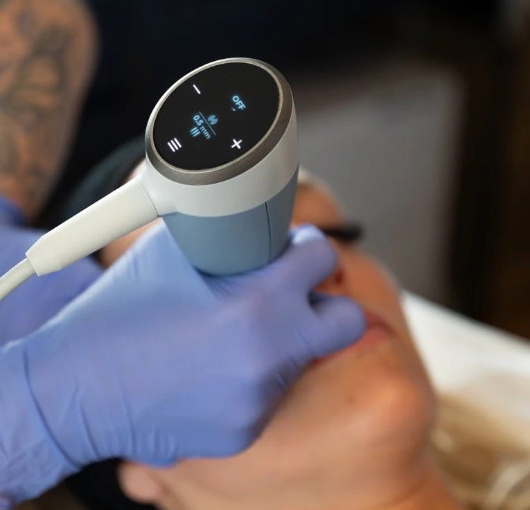 woman getting microneedling done