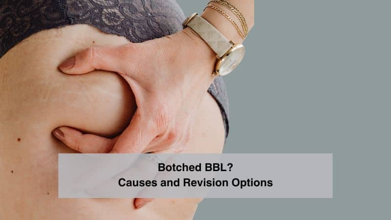 Botched BBL? Causes and Revision Options | Plastic Surgery Dallas