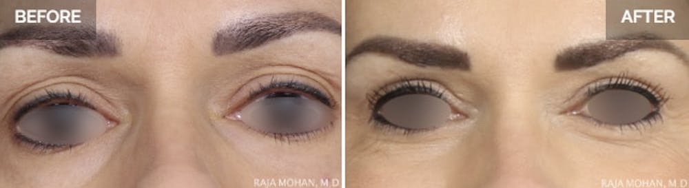 Photos one week after eyelid surgery