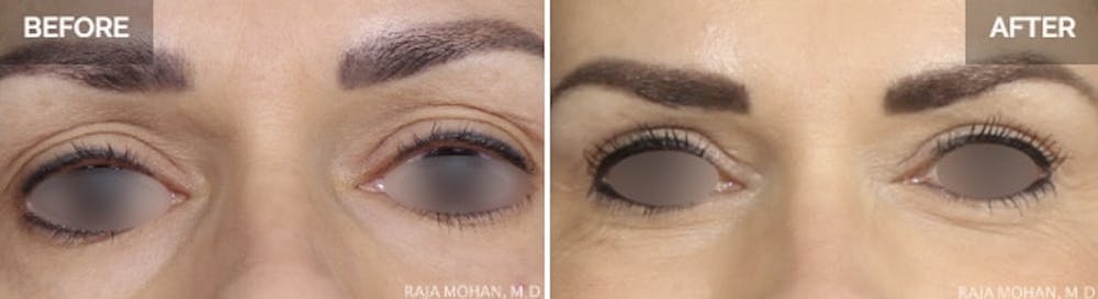 Photos one week after eyelid surgery Photos one week after eyelid surgery