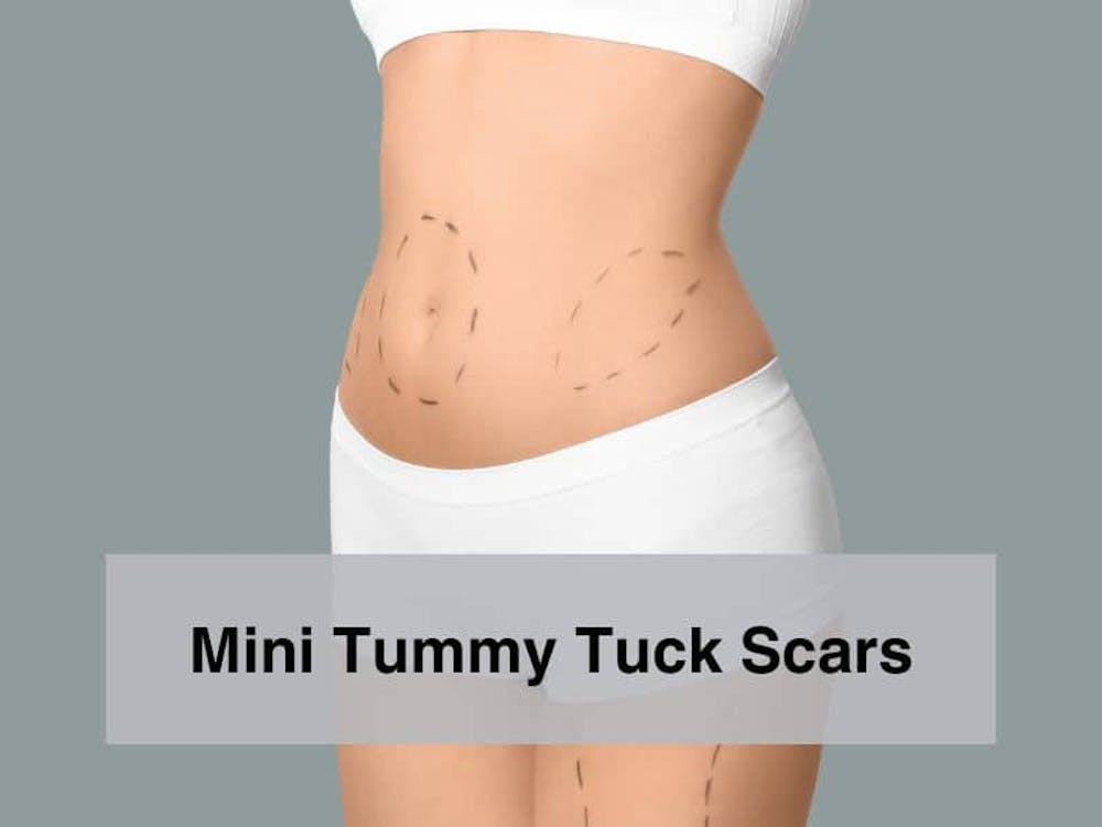 Mini Tummy Tuck Scars