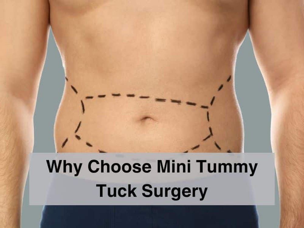 Why Choose Mini Tummy Tuck Surgery