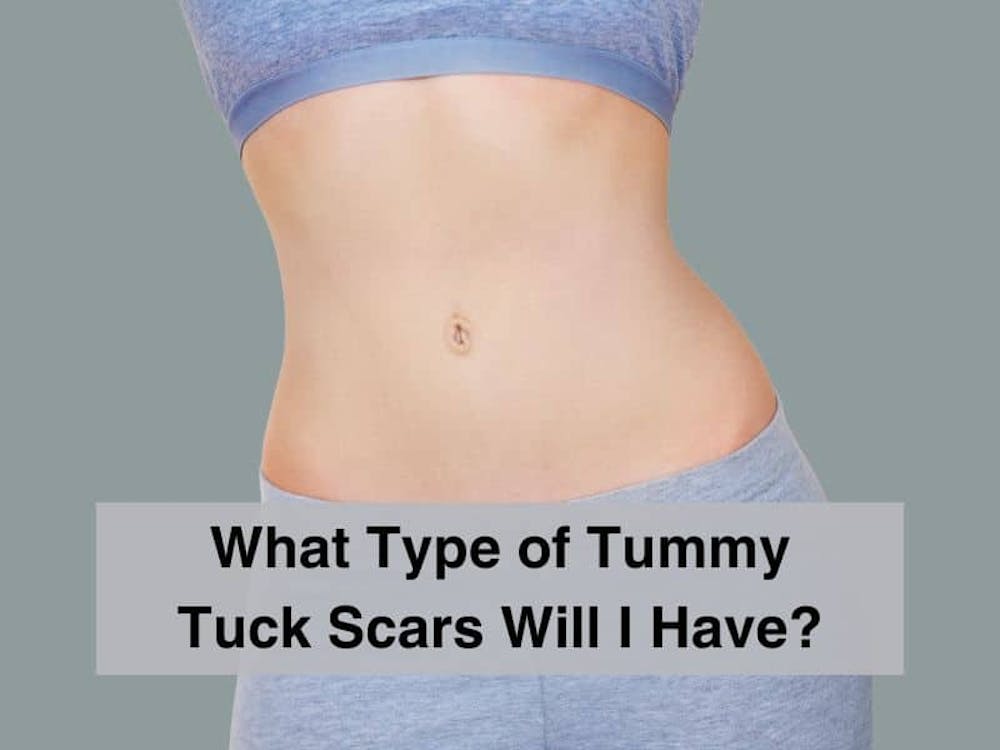 What Type of Tummy Tuck Scars Will I Have