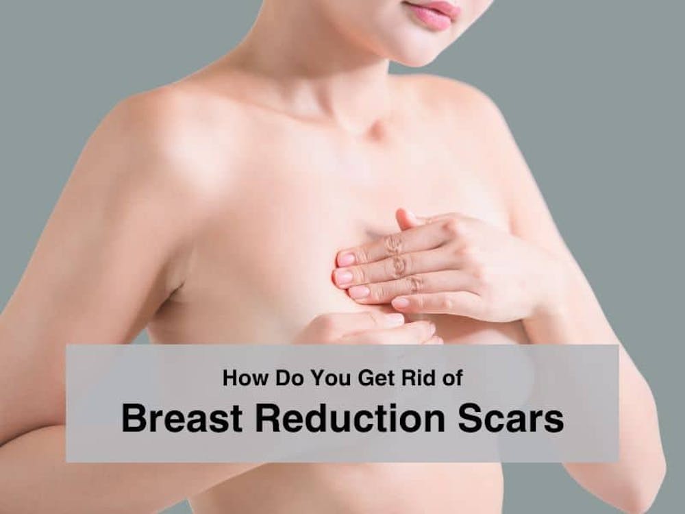 How do you get rid of breast reduction scars
