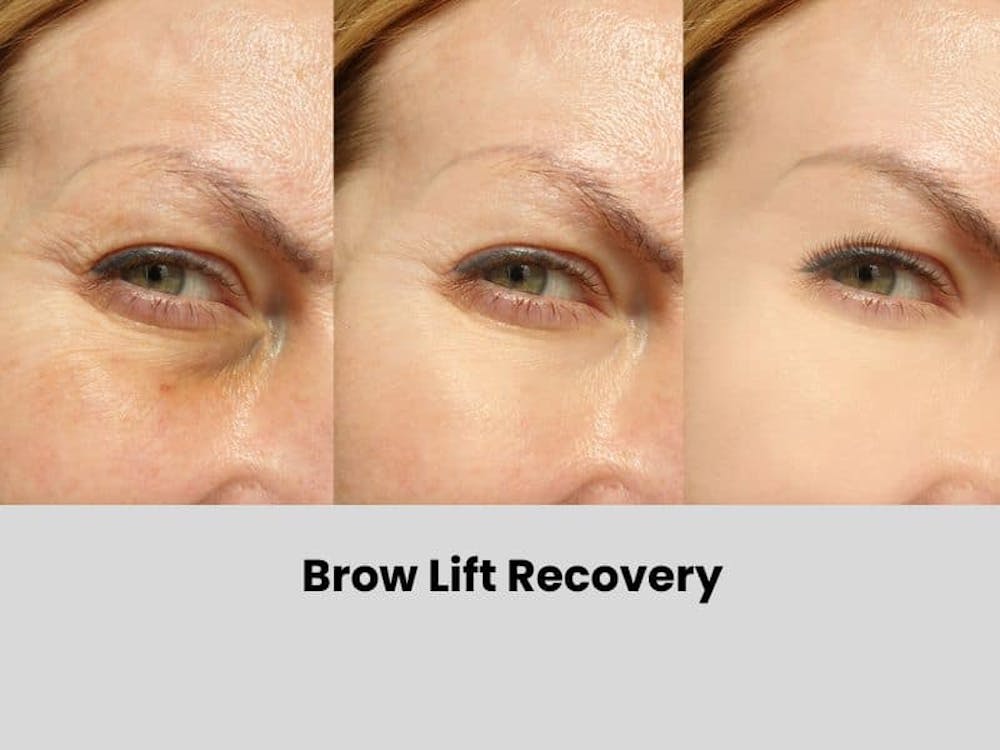 Brow Lift Recovery Tips