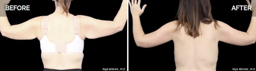 Arm lift before and after scar