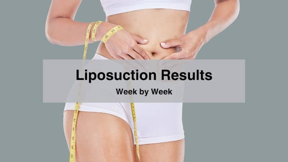 Liposuction results week by week