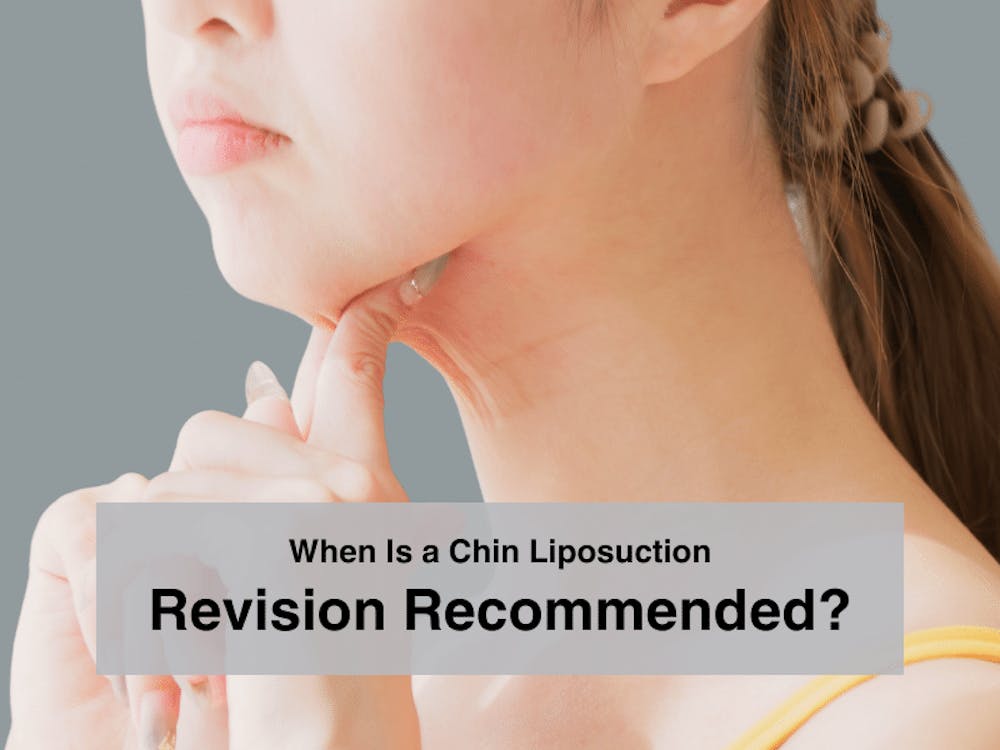 When Is a Chin Liposuction Revision Recommended