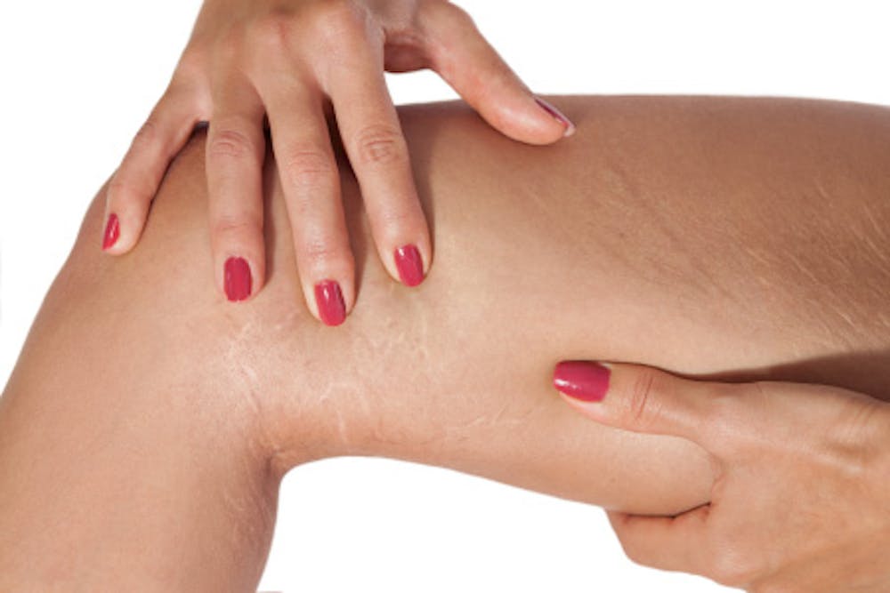 Lipo scar removal Lipo scar removal