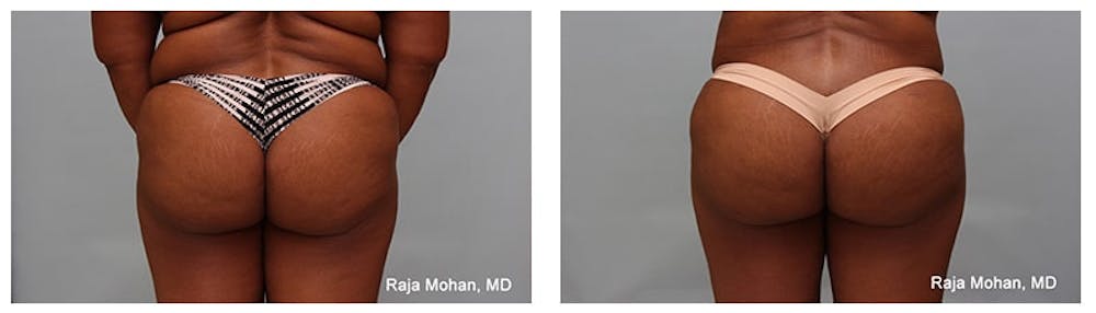 Dr. Raj Plastic Surgeon Dallas - How long after bbl can I sit without pillow