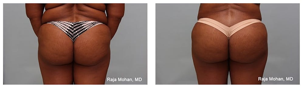 Dr. Raj Plastic Surgeon Dallas - How long after bbl can I sit without pillow Dr. Raj Plastic Surgeon Dallas - How long after bbl can I sit without pillow