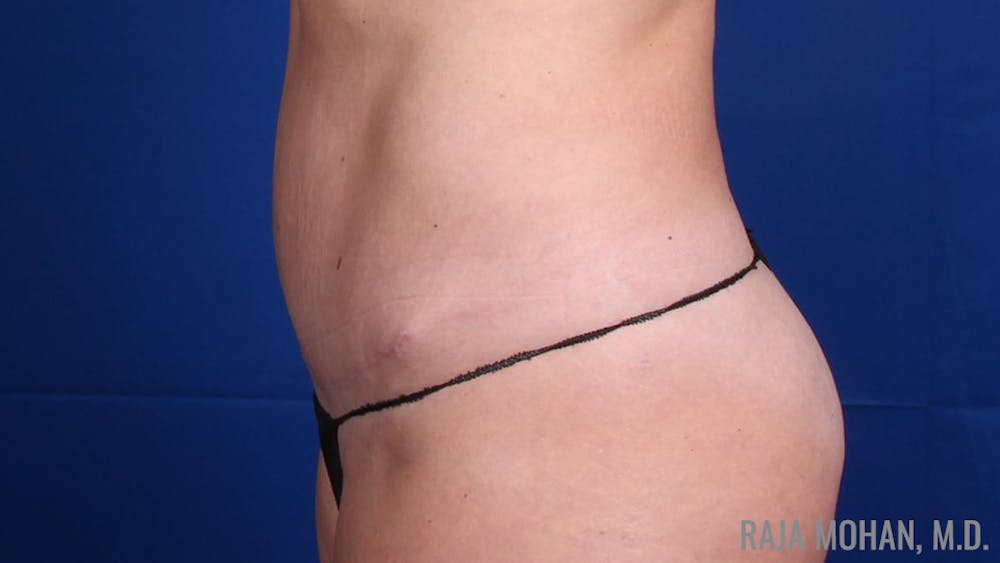 Tummy Tuck Vs Lipo