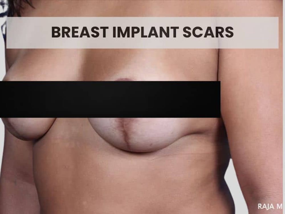 BREAST IMPLANT SCARS
