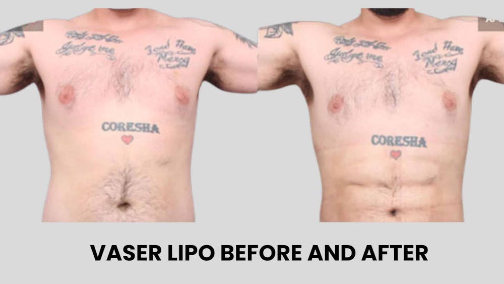 Vaser lipo before and after Vaser lipo before and after