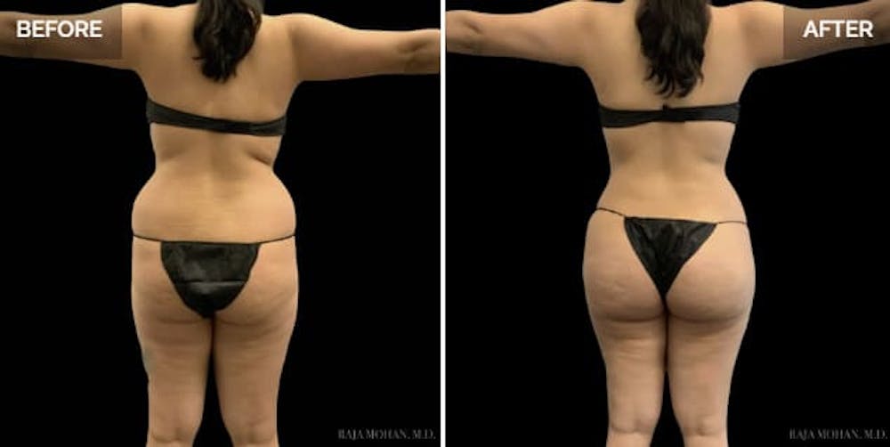 BBL Before and After BBL Before and After